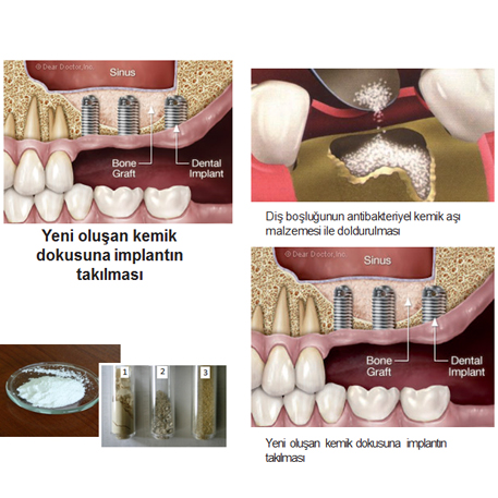 Antibakteriyel Kemik Aşı Malzemesi